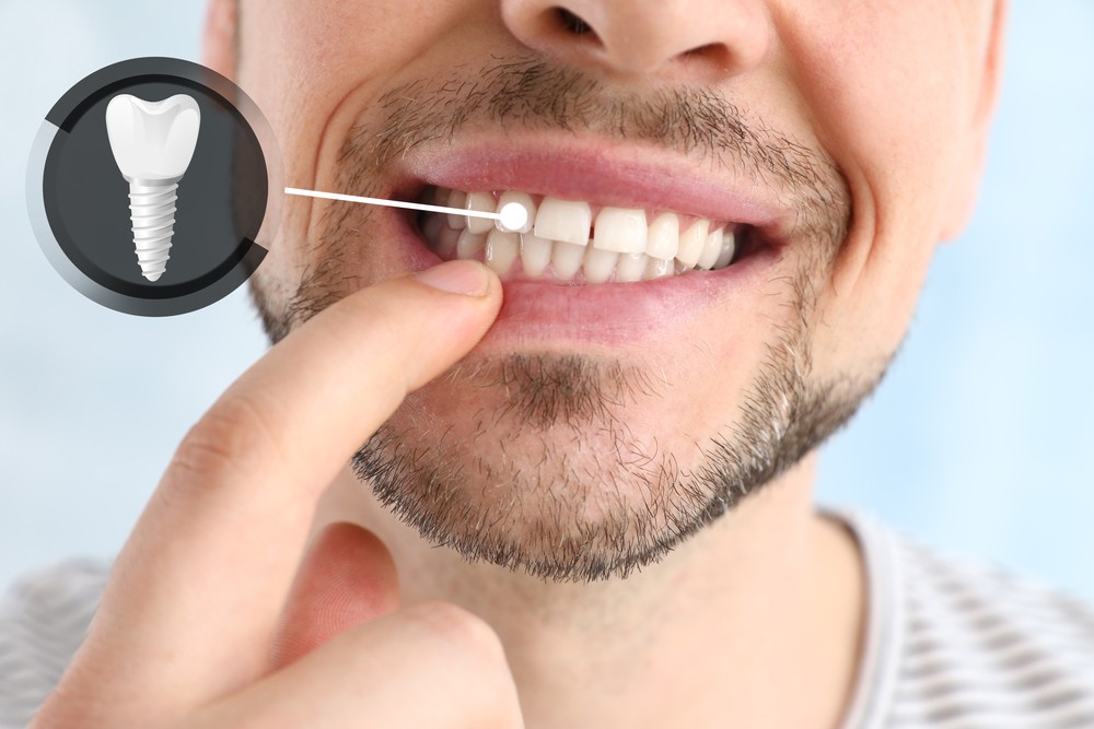 implant dentar bucuresti, implantologie, clinica stomatologica luxury smile