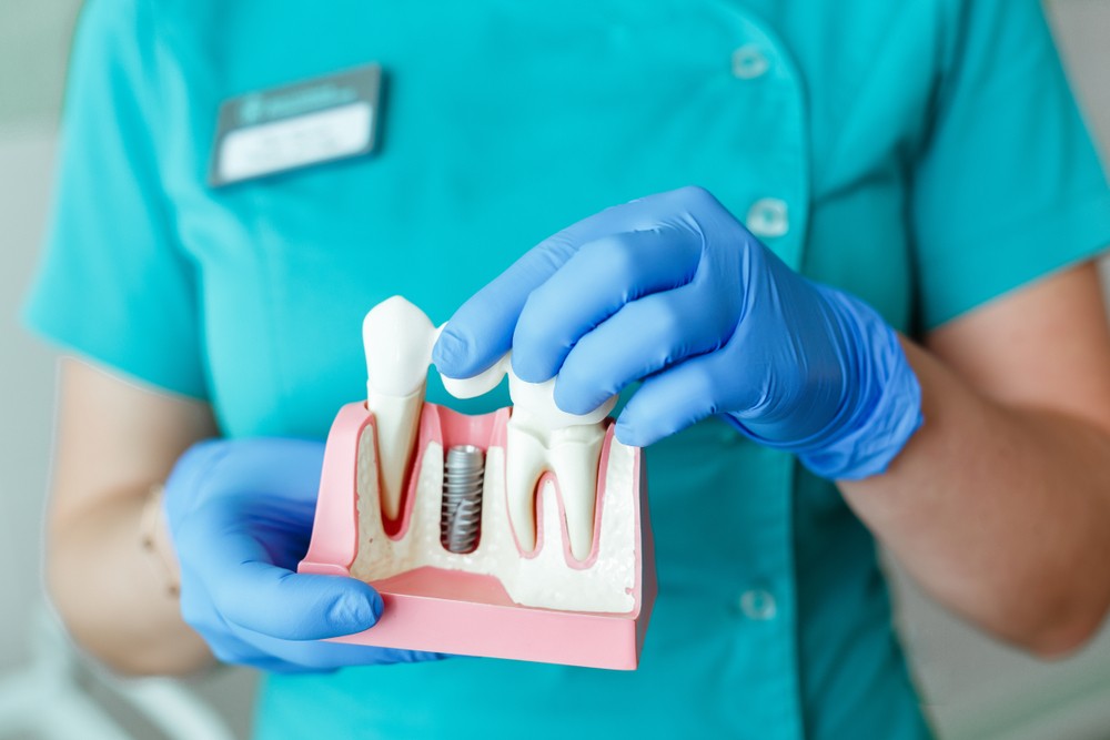 implant dentar bucuresti, implantologie, clinica stomatologica luxury smile