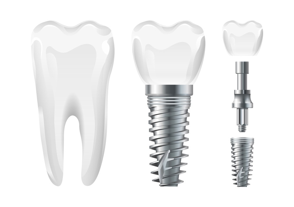 Implant dentar București