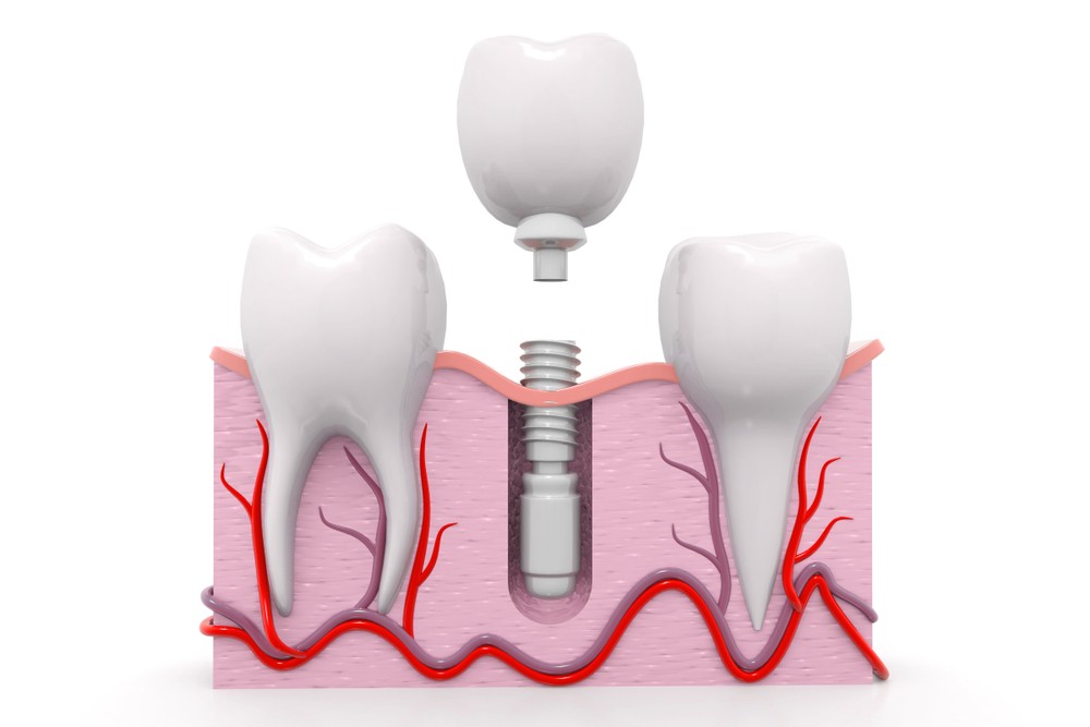 implant dentar bucuresti, implantologie bucuresti, clinica stomatologica luxury smile bucuresti