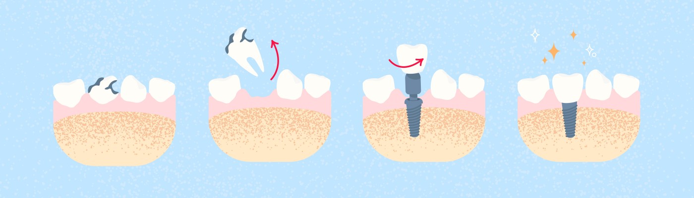 Implant dentar București