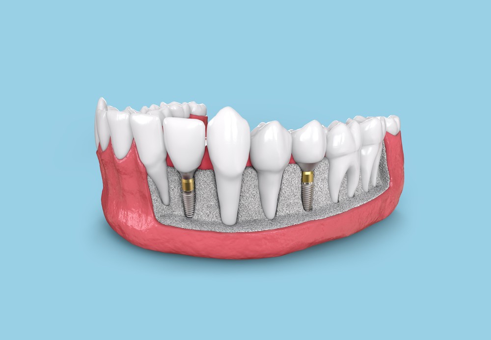 implant dentar București